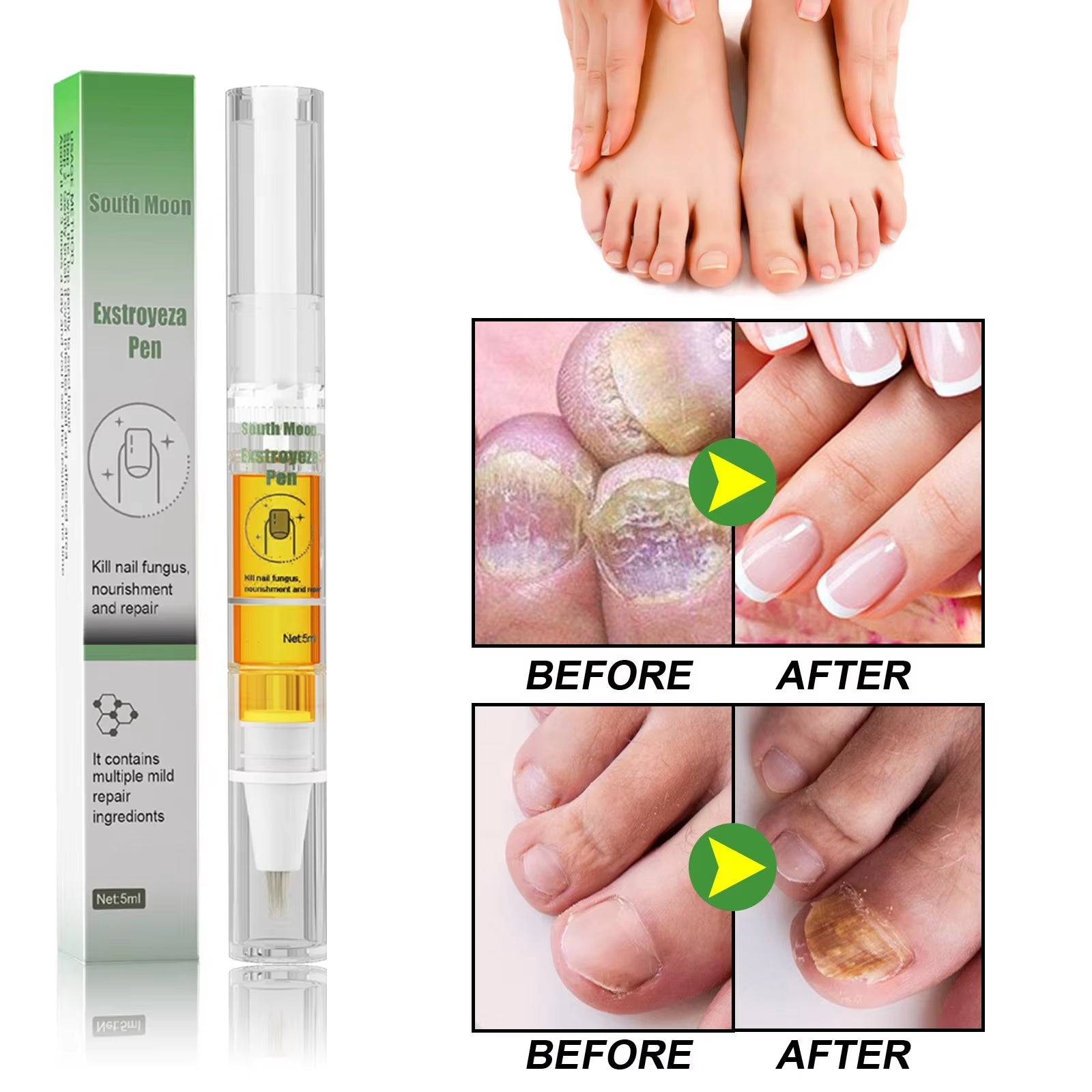 Nail Fungus Repair Pen Remove Onychomycosis Paronychia Reduce Toe Infection Brighten Nail Hand Foot Nail Care Liquid