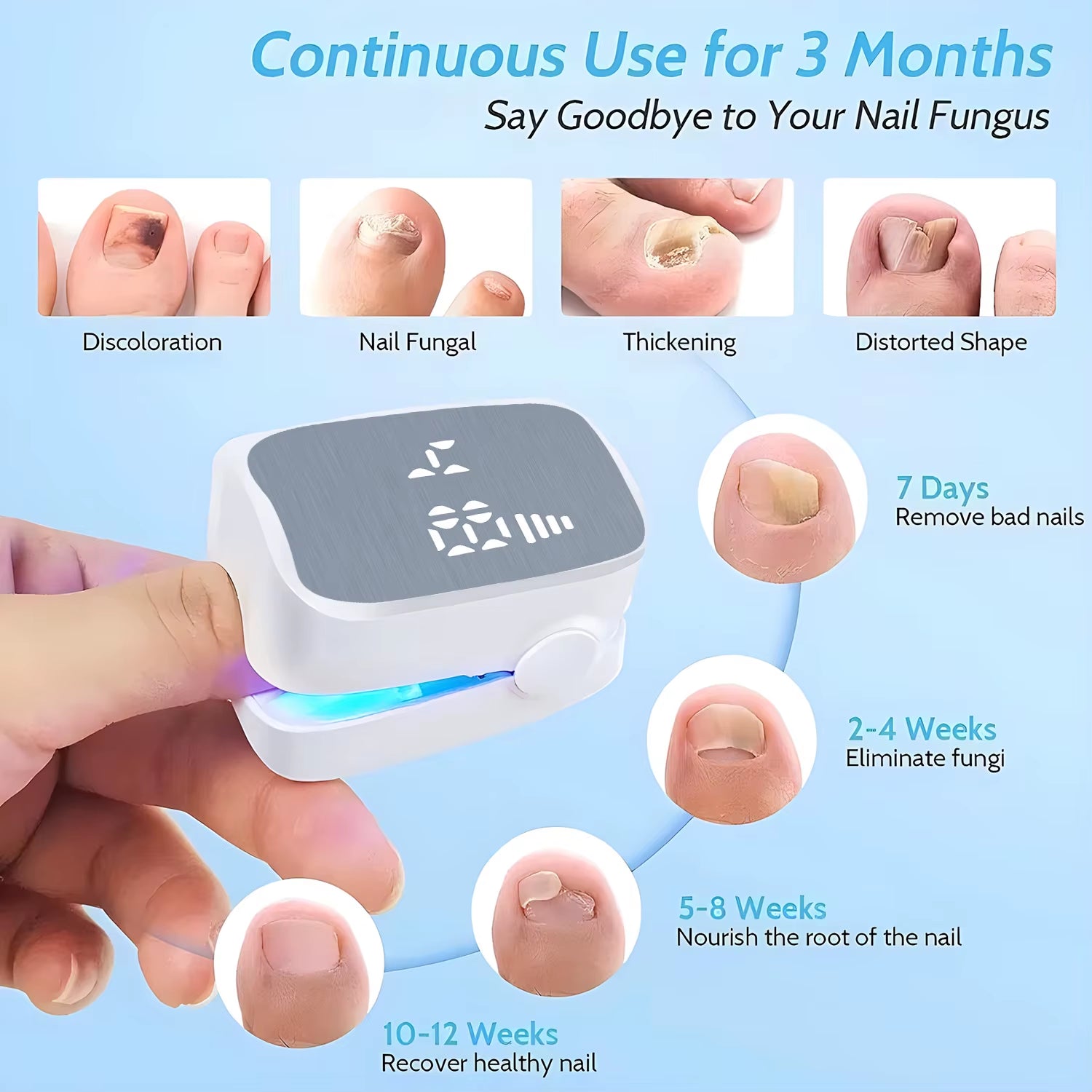Nail Fungus Treatment LED Laser Device for Cleaning Onychomycosis USB Charge 905Nm Infrared Light 470Nm Blue Light Nail Salon