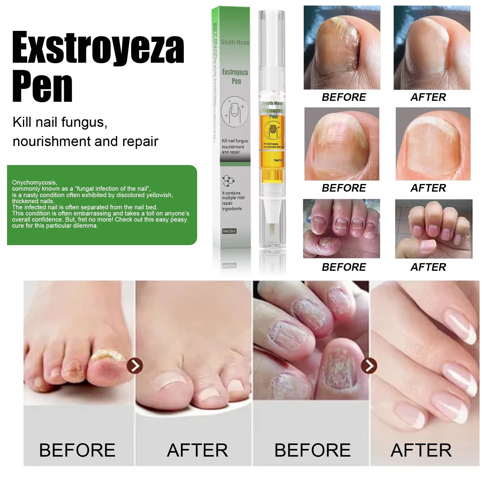 Nail Fungus Repair Pen Remove Onychomycosis Paronychia Reduce Toe Infection Brighten Nail Hand Foot Nail Care Liquid